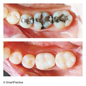 Mercury Fillings